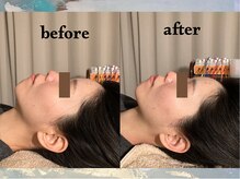 寝譜(nefu)/美容鍼BeforeAfter