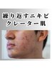 【メンズ専用】本格ニキビケア☆なめらか肌へ!80分12000円→