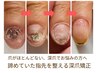 【深くお悩みの方へ】諦めていた指先を整える深爪矯正