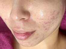 バタフライ 津田沼店(Butterfly)/頑固な赤ニキビにさよなら！