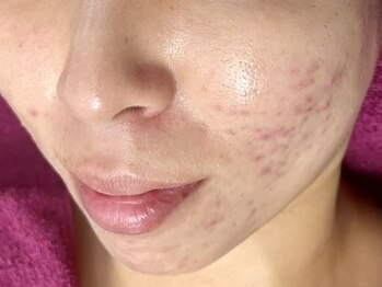 バタフライ 津田沼店(Butterfly)/頑固な赤ニキビにさよなら!