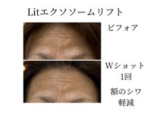 フラワー(FLOWER)/Lit1回額のシワも薄くなりました