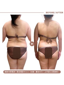 イエス マイサロン(yes My Salon)の写真/【脂肪冷却×骨盤底筋】で叶えるぺたんこお腹！インナーマッスルと皮下脂肪へのWアプローチで確かな結果へ