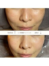 リル 和歌山市店(lilou)/話題のヒト幹細胞フェイシャル♪