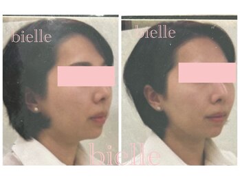 ビエル(Bielle)/下垂の原因を根本からケア