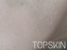 トップスキン 表参道(TOPSKIN)/ハーブピーリングTCLINE剥離中