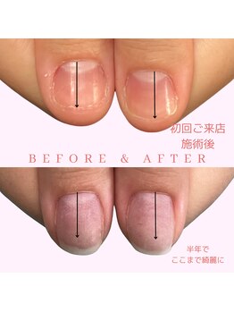 深爪育成(半年経過)