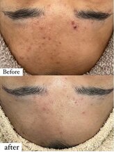 ホワイトアクア 姫路店(WHITE AQUA)/ララピール/姫路/美肌