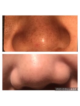 サロンド ヴィーナス 葛西店/毛穴ケアも効果期待◎