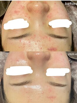 フルール(Fleur)/◆肌荒れ/赤み/鎮静◆