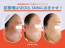 ソウルスキン