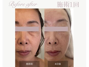 パルタージュ(Partage)/ACトリートメント