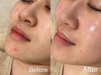 シェリーミル(Cherie Miru)/しつこいニキビケア