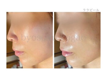 メディカルエステ 新宿南口店/*ララピール症例写真*