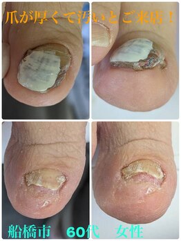 巻き爪じゅん 船橋店/厚くて汚い爪どうにかして！