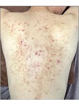 リベル 名古屋(Lebelle:)/ハーブピーリング専門名古屋