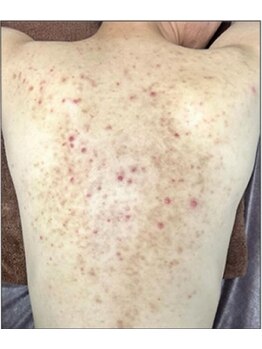 リベル 名古屋(Lebelle:)/ハーブピーリング専門名古屋