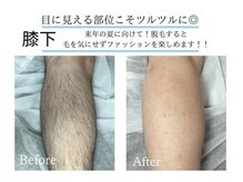 アルゴ 吹田千里山駅前店(ALGO)/【メンズボディの脱毛】