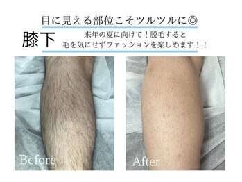 アルゴ 吹田千里山駅前店(ALGO)/【メンズボディの脱毛】