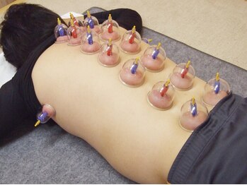 手なおし健康整体/吸い玉（カッピング療法）