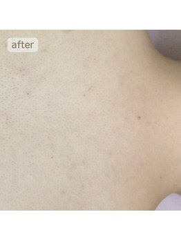 ビューティフィーサロン ベルル(Belulu)/背中～えりあし脱毛アフター