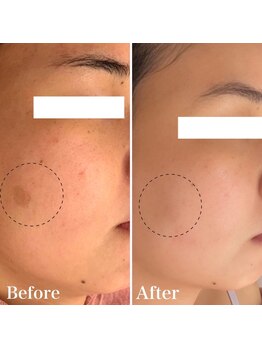 パールホワイトニングサロン 町田店/大きいシミ改善も一緒に！