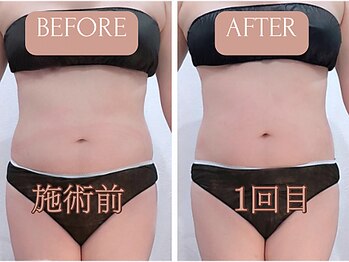 ルッカ(RUKKA)/【 お腹 】ビフォーアフター