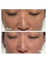 ピュア 川越店/光＋バイポレーション＋生マスク