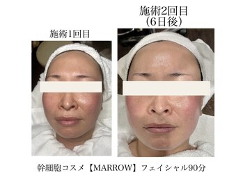 クローバー アキ(CLOVER.aki.)/フェイシャル