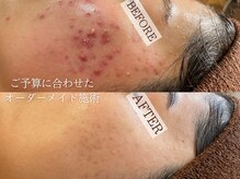 ラヴェリテ(La verite)の雰囲気（深いお悩み／アクネケアもお任せください★自信の持てるお肌へ♪）