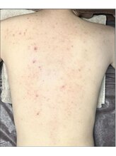 リベル 名古屋(Lebelle:)/ハーブピーリング専門名古屋