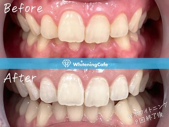 ホワイトニングカフェ 原宿店/◎歯のホワイトニング施術写真◎