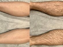 バタフライ 津田沼店(Butterfly)/美肌脱毛