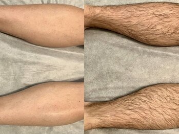 バタフライ 津田沼店(Butterfly)/美肌脱毛