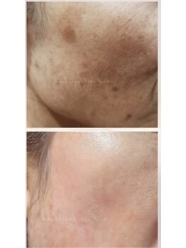 ミーラブ 鹿児島(miilove)/10年前のお肌へ最強エイジング