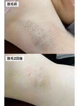 サロン デ リブレ 高松店(salon de Libre)/【脱毛】2回の脱毛で変化大！