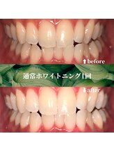 フタバ 天神大名店(futaba)/初回ホワイトニングbefore after