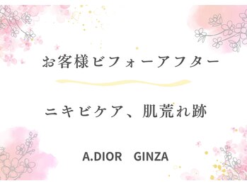 エーディオールギンザ(A.DIOR GINZA)/ニキビケア、肌荒れ