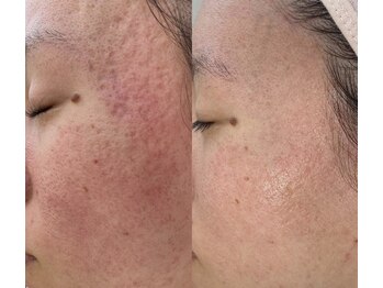 ルチル(Rutile)/プロセルセラピーズフェイシャル