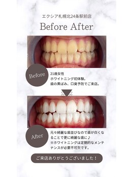 エクシアホワイト 平岸駅前店/ホワイトニング☆口コミのご紹介