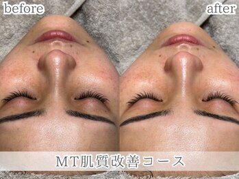 ミック(Mecc)/MT肌質改善コース60分