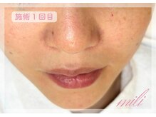 ミリ 千葉店(mili)/毛穴の開きを改善