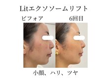 フラワー(FLOWER)/Lit6回目 継続する事でハリツヤ