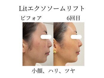 フラワー(FLOWER)/Lit6回目 継続する事でハリツヤ