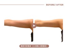イエス マイサロン(yes My Salon)/脂肪冷却施術例