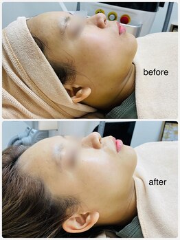 KMB 恵比寿店/毛穴洗浄+光+炭酸ガスパック