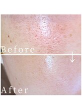 サロン レインボー(SALON RAINBOW)/ハーブピーリングBefore/After