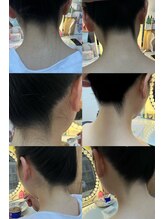 ミナミ/うなじ脱毛（Revoimpact）