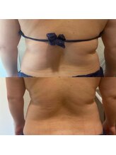 シュシュ(Chou chou)/痩身 Before＆After