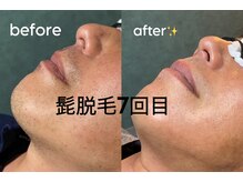 リセルグロウ(Recell grow)/